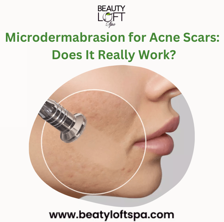 Microdermabrasion for Acne Scars: Does It Really Work?