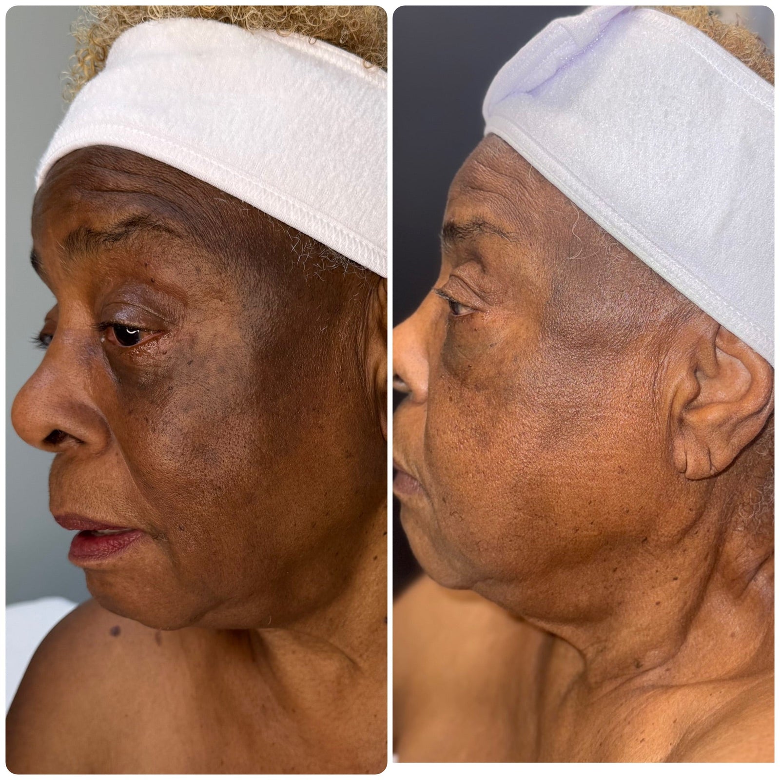 Microneedling Aftercare: Protect Your Results & Boost Skin Longevity