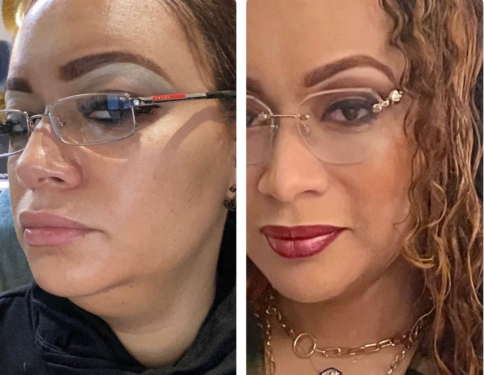 Non-Surgical Double Chin Removal in Atlanta: Step-by-Step Mesotherapy Fat Dissolver Treatment