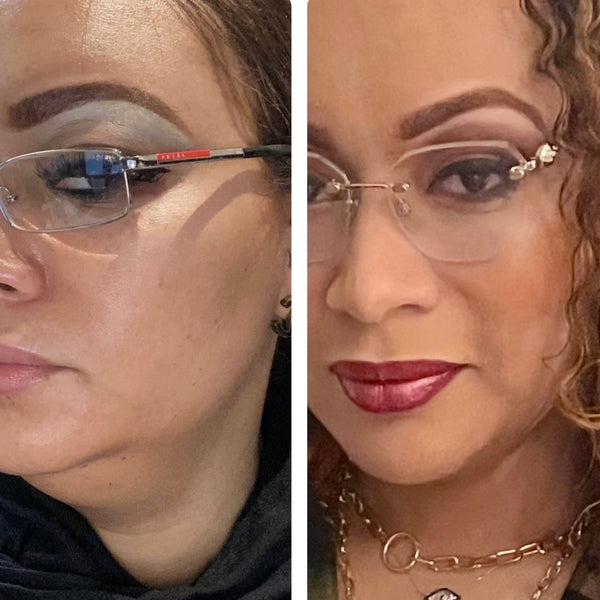 Non-Surgical Double Chin Removal in Atlanta: Step-by-Step Mesotherapy Fat Dissolver Treatment