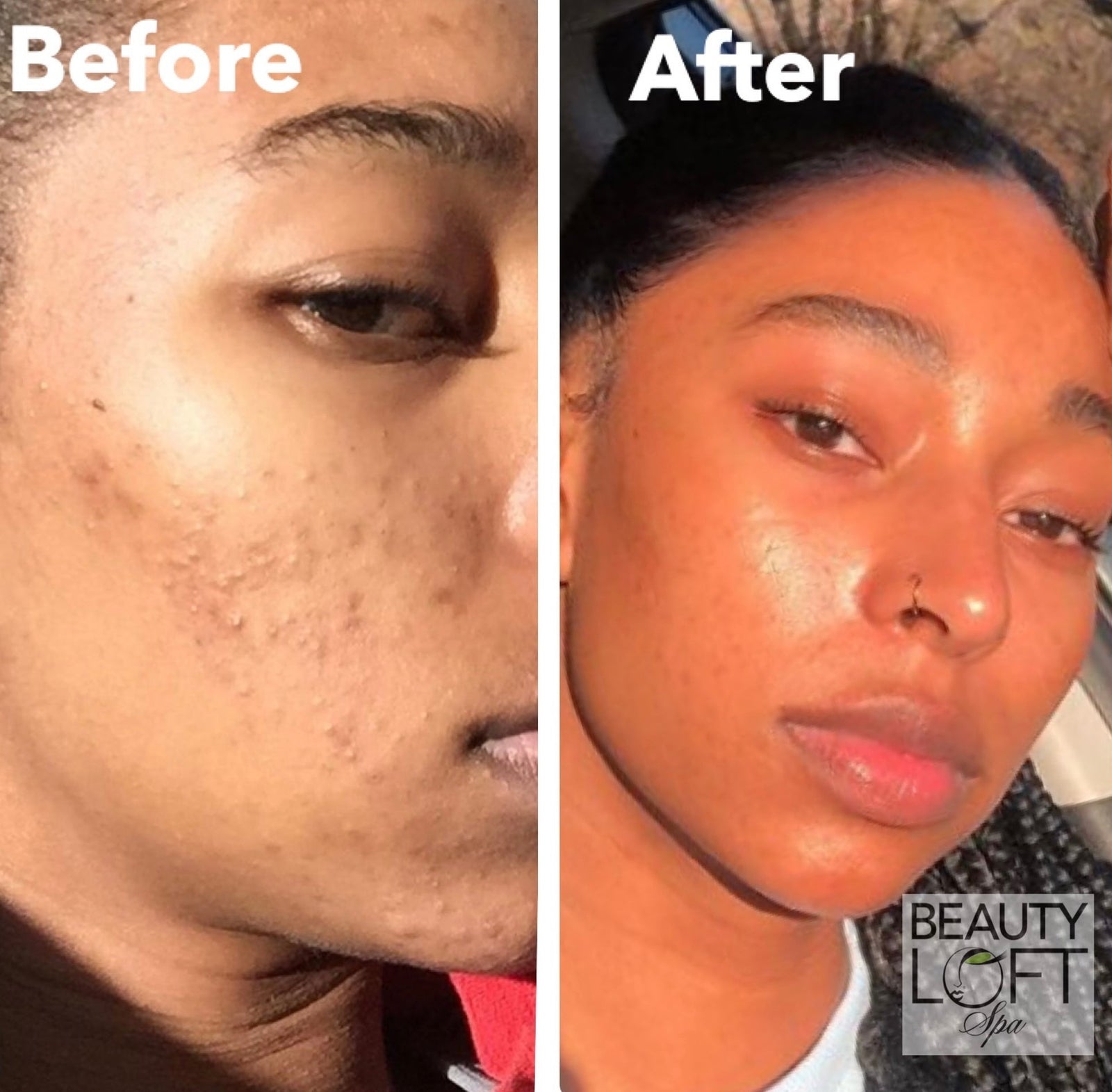 Skin Longevity for African-American Skin: The Treatments That Help Your Glow Last