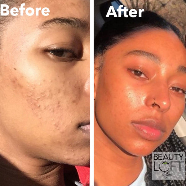 Skin Longevity for African-American Skin: The Treatments That Help Your Glow Last