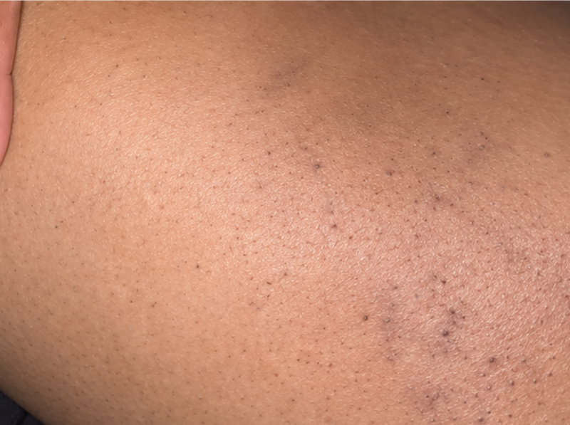 After Treatment