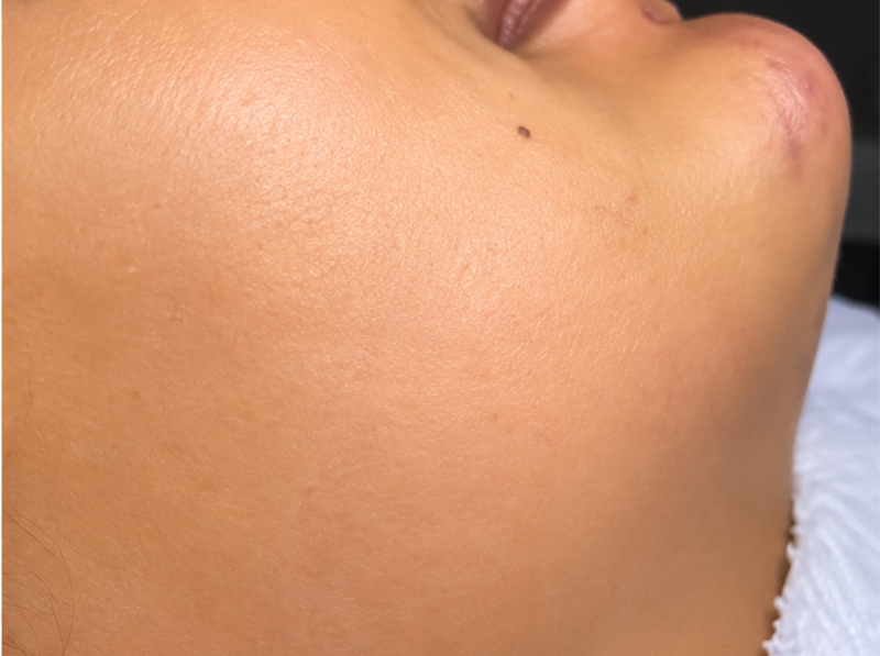 After Treatment