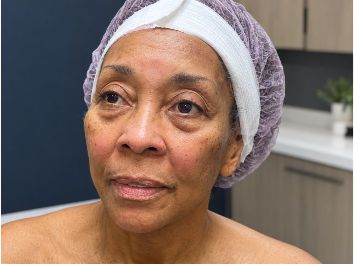 Before Radiofrequency Skin Tightening