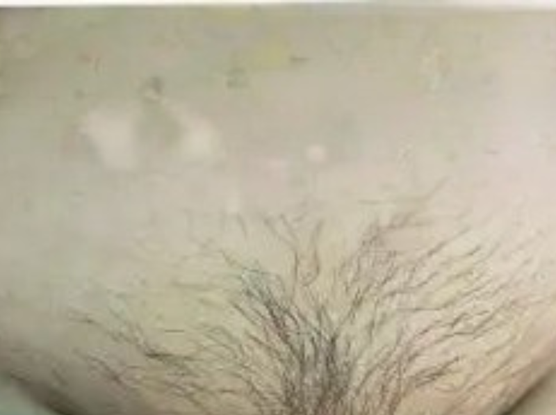 Before Treatment