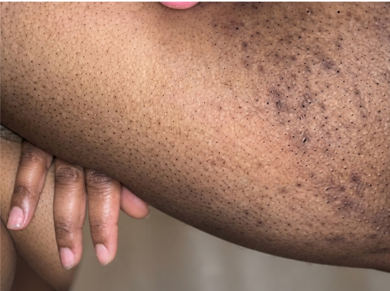 Before Treatment