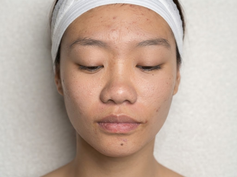 Before Treatment