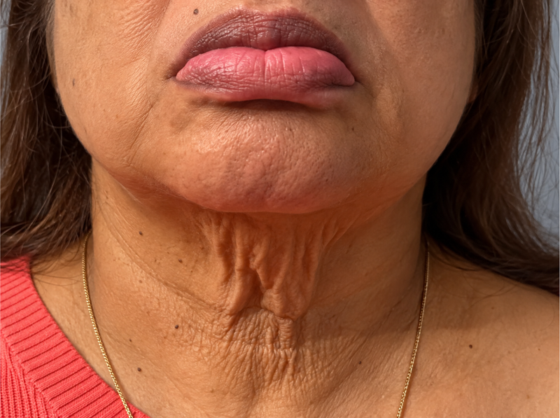 Before Treatment