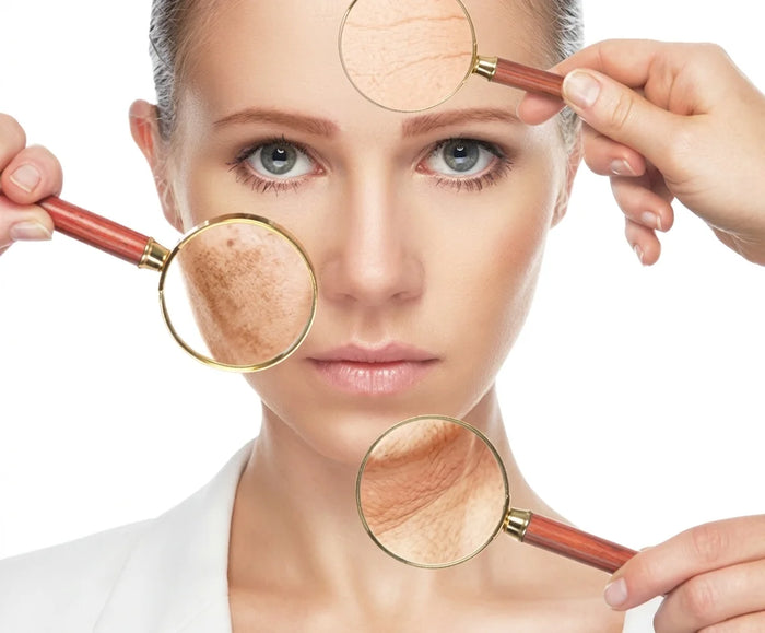 Chemical Peels