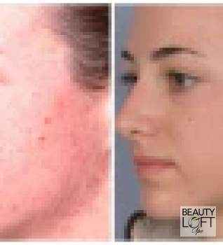 Microdermabrasion