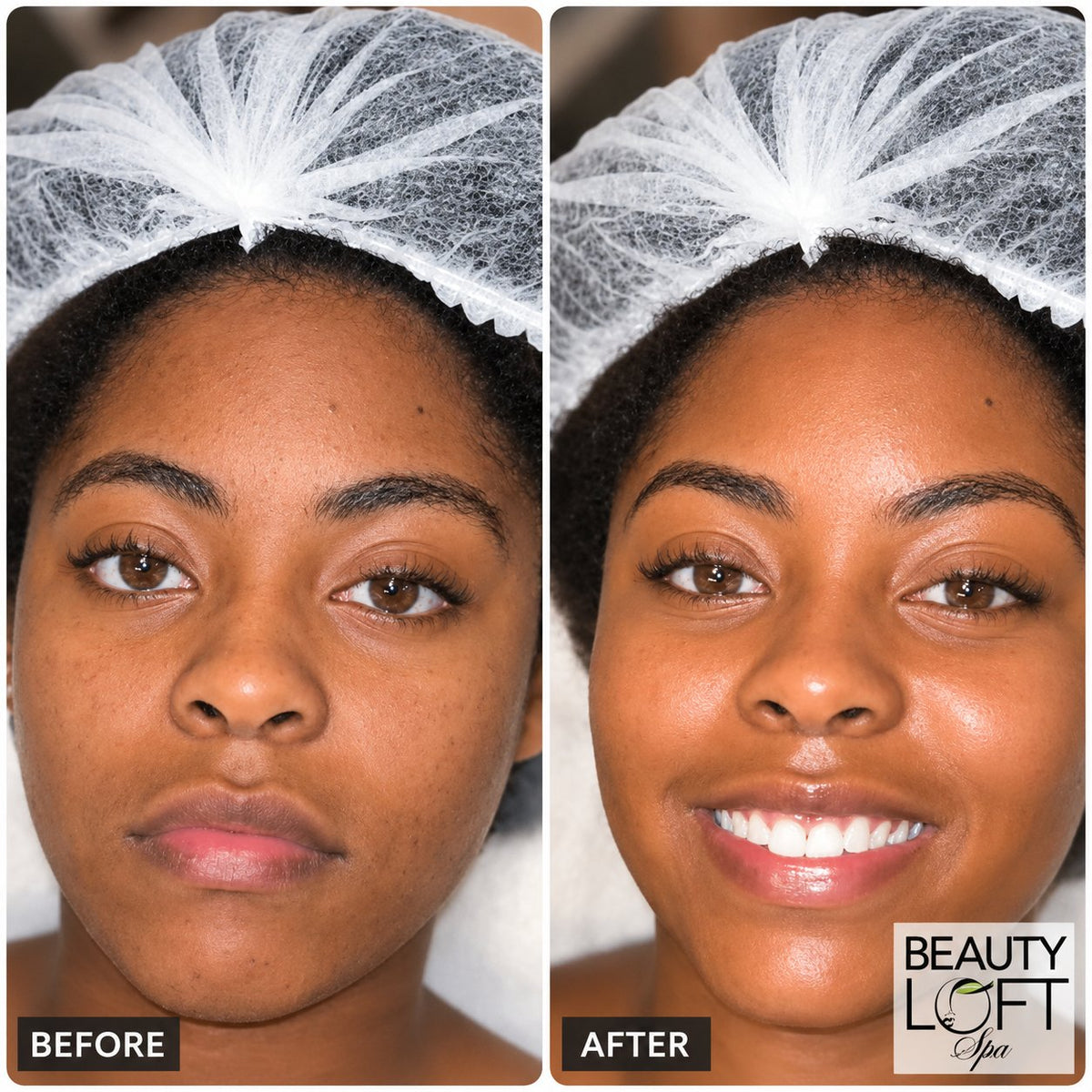 Teen Confidence Facial