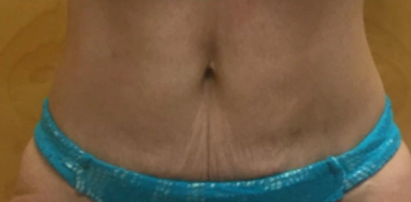 After Treatment