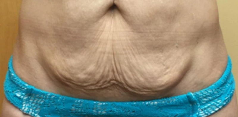 Before Treatment