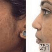 Micro Needling - Beauty Loft Spa