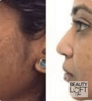 Micro Needling - Beauty Loft Spa