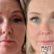 Micro Needling - Beauty Loft Spa