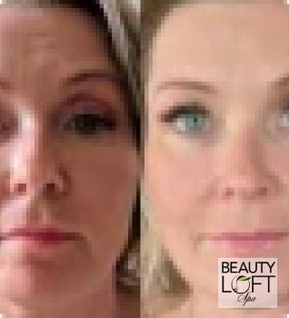 Micro Needling - Beauty Loft Spa