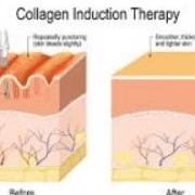 Micro Needling - Beauty Loft Spa