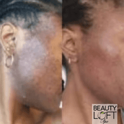 Micro Needling - Beauty Loft Spa