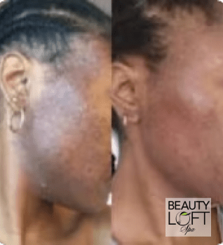 Micro Needling - Beauty Loft Spa