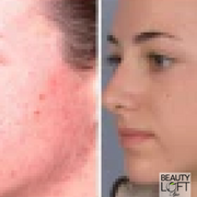Microdermabrasion - Beauty Loft Spa