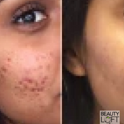 Microdermabrasion - Beauty Loft Spa