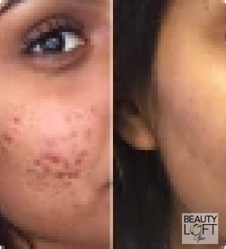 Microdermabrasion - Beauty Loft Spa